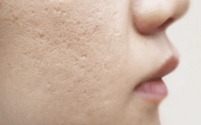 Acne Scar Removal: Are DIY Treatments Effective?